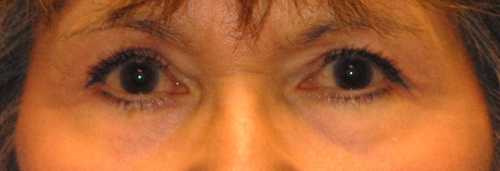 Patient 2 after photo of Laser EyeLid Lift patient at Sensational Skin Scottsdale