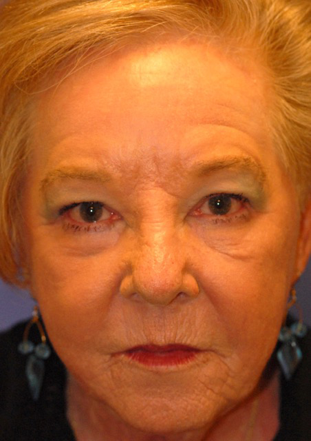 After Face Procedures patient
