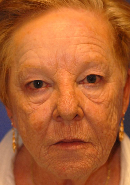 Before Face Procedures patient