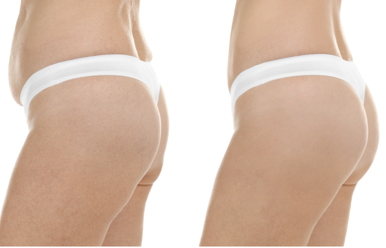 Sculptra Butt Lift | Dr. Brown Conveniently located to serve Scottsdale, Arizona
