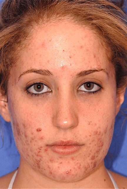Patient 4 before photo of Acne Scars patient at Sensational Skin Scottsdale