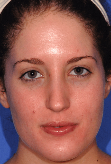 Patient 4 after photo of Acne Scars patient at Sensational Skin Scottsdale