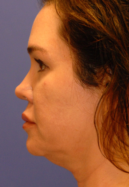 Patient 4 before photo of Profound Lift patient at Sensational Skin Scottsdale