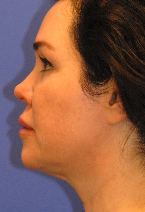 Patient 4 after photo of Profound Lift patient at Sensational Skin Scottsdale