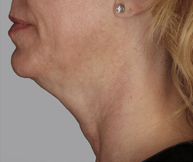 Patient 3 before photo of Profound Lift patient at Sensational Skin Scottsdale