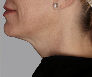 Patient 3 after photo of Profound Lift patient at Sensational Skin Scottsdale
