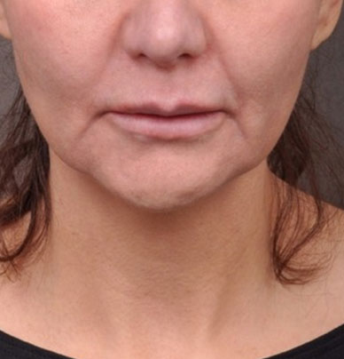 Patient 1 before photo of Profound Lift patient at Sensational Skin Scottsdale