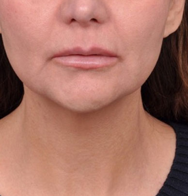 Patient 1 after photo of Profound Lift patient at Sensational Skin Scottsdale