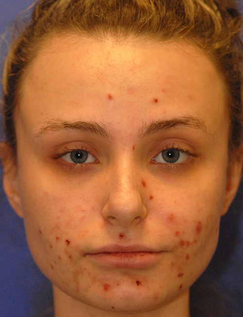 Patient 3 before photo of Acne & Acne Scar Laser Treatment patient at Sensational Skin Scottsdale