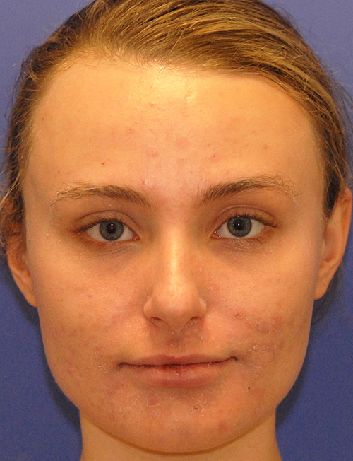 Patient 3 after photo of Acne & Acne Scar Laser Treatment patient at Sensational Skin Scottsdale