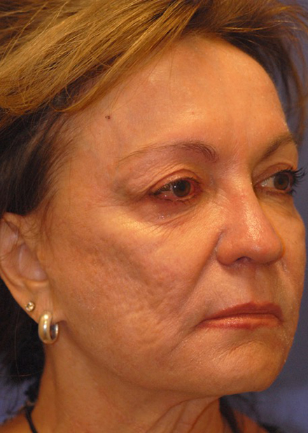 Patient 5 before photo of Face Procedures patient at Sensational Skin Scottsdale