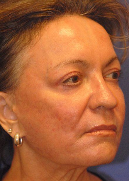 Patient 5 after photo of Face Procedures patient at Sensational Skin Scottsdale
