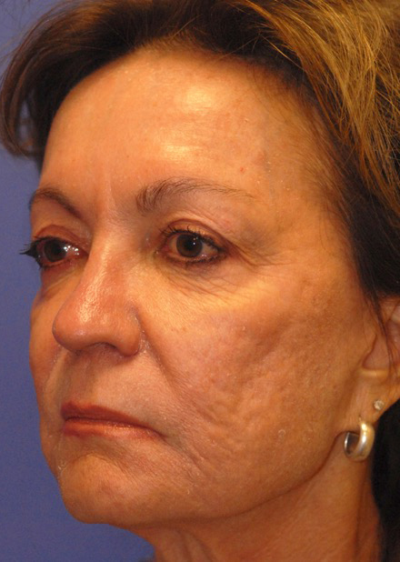 Patient 5 before photo of Face Procedures patient at Sensational Skin Scottsdale