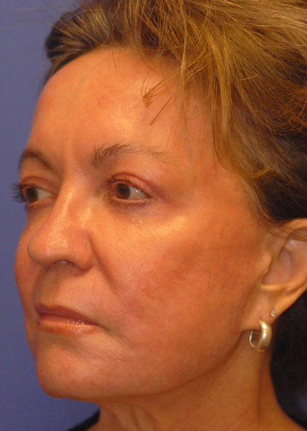 Patient 5 after photo of Face Procedures patient at Sensational Skin Scottsdale