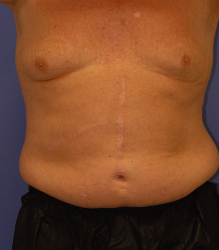 Patient 9 before photo of Coolsculpting patient at Sensational Skin Scottsdale