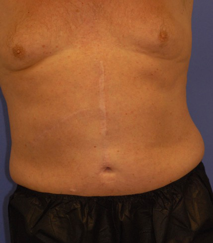 Patient 9 after photo of Coolsculpting patient at Sensational Skin Scottsdale