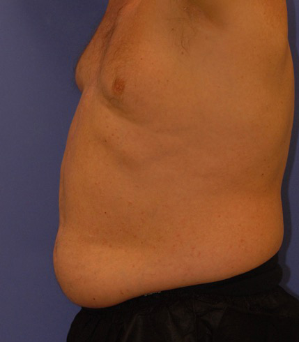 Patient 9 before photo of Coolsculpting patient at Sensational Skin Scottsdale
