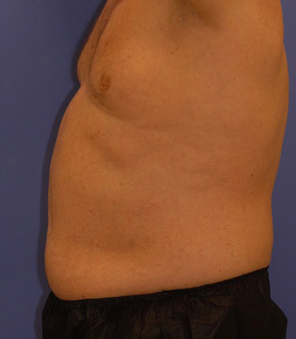 Patient 9 after photo of Coolsculpting patient at Sensational Skin Scottsdale