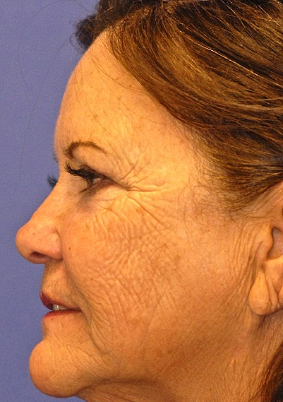Patient 3 before photo of ZO Medical patient at Sensational Skin Scottsdale
