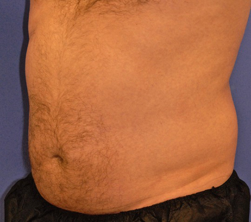 Patient 10 before photo of Coolsculpting patient at Sensational Skin Scottsdale