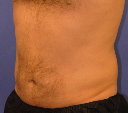 Patient 10 after photo of Coolsculpting patient at Sensational Skin Scottsdale