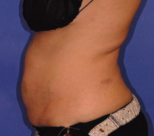 Patient 12 before photo of Coolsculpting patient at Sensational Skin Scottsdale