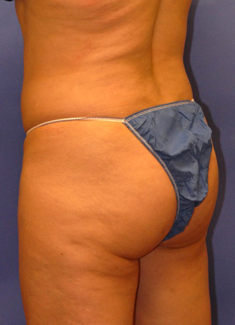 Patient 1 before photo of Profound RF patient at Sensational Skin Scottsdale