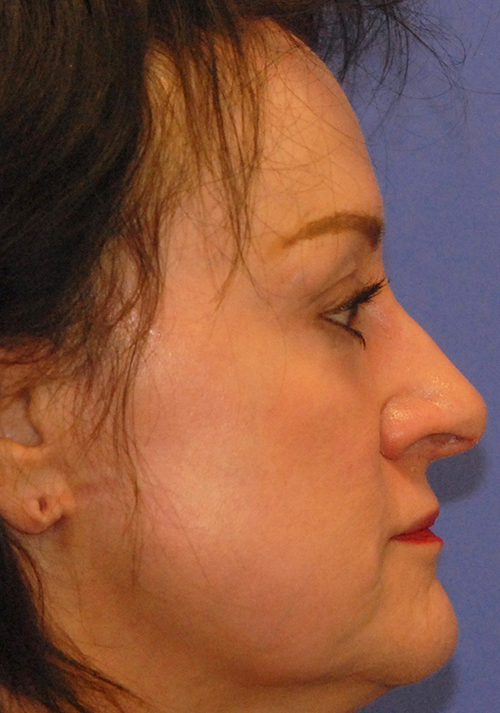 Patient 6 after photo of Face Procedures patient at Sensational Skin Scottsdale