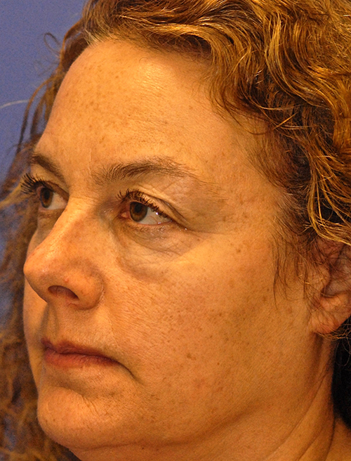 Patient 1 before photo of Active FX / Deep FX Laser Therapy patient at Sensational Skin Scottsdale