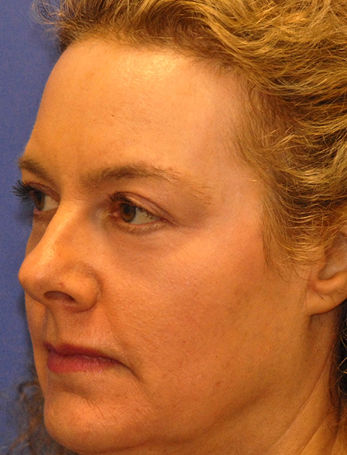 Patient 1 after photo of Active FX / Deep FX Laser Therapy patient at Sensational Skin Scottsdale