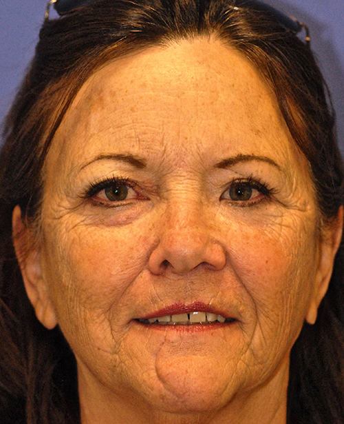 Before MaxFX CO2 Laser Resurfacing patient
