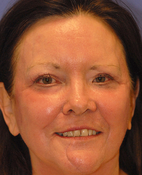After MaxFX CO2 Laser Resurfacing patient
