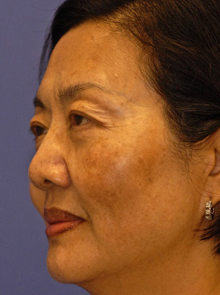 Patient 13 before photo of ZO Skin Health patient at Sensational Skin Scottsdale