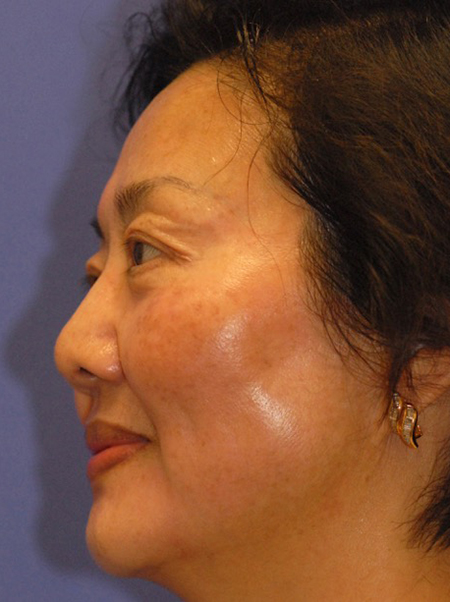 Patient 13 after photo of ZO Skin Health patient at Sensational Skin Scottsdale
