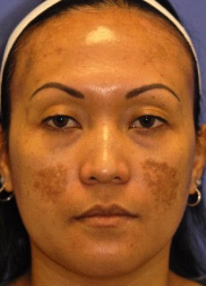 Patient 4 before photo of Melasma patient at Sensational Skin Scottsdale