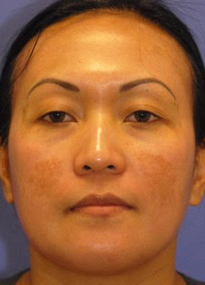 Patient 4 after photo of Melasma patient at Sensational Skin Scottsdale