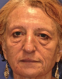 Patient 9 before photo of Face Procedures patient at Sensational Skin Scottsdale