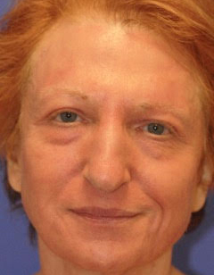 Patient 9 after photo of Face Procedures patient at Sensational Skin Scottsdale