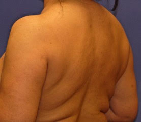 Patient 11 before photo of Coolsculpting patient at Sensational Skin Scottsdale