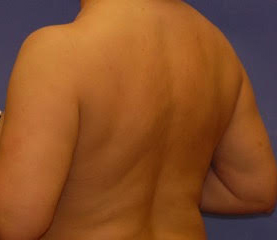 Patient 11 after photo of Coolsculpting patient at Sensational Skin Scottsdale