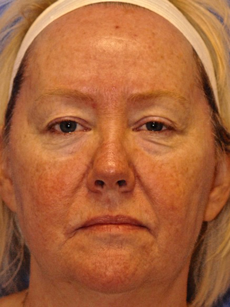 Patient 8 before photo of Face Procedures patient at Sensational Skin Scottsdale