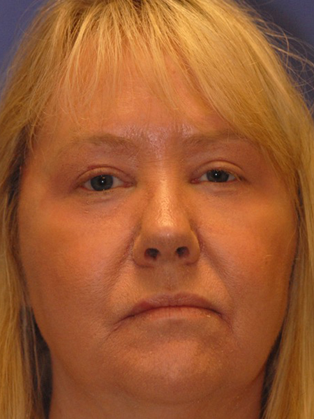 Patient 8 after photo of Face Procedures patient at Sensational Skin Scottsdale