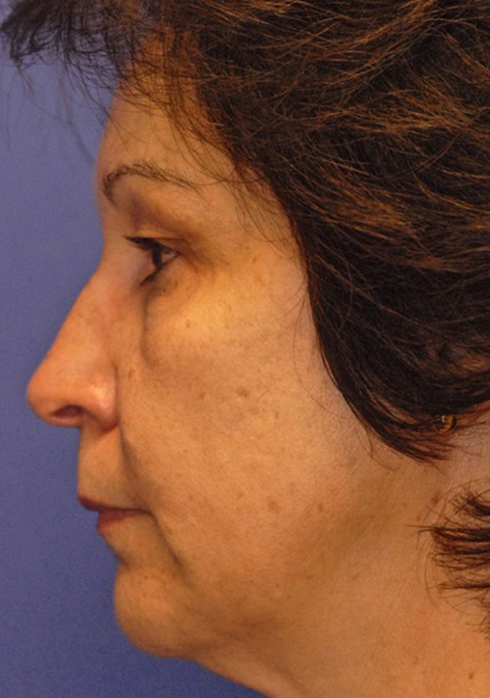 Before ZO Skin Health patient
