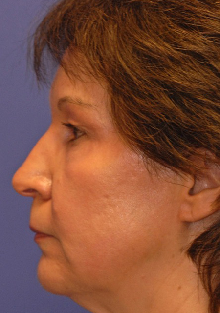 After ZO Skin Health patient
