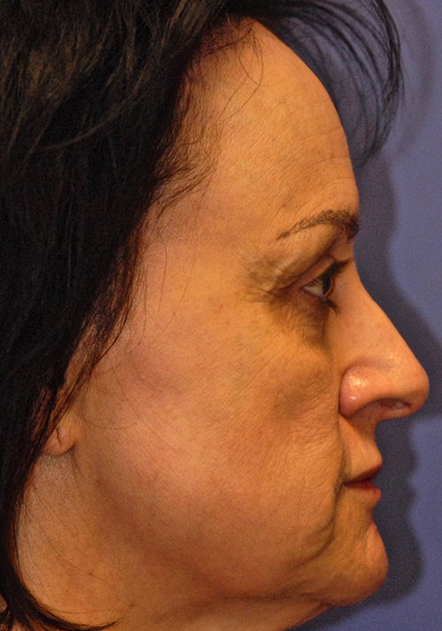 Patient 2 before photo of Active FX / Deep FX Laser Therapy patient at Sensational Skin Scottsdale