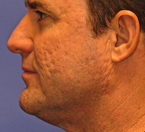 Before MaxFX CO2 Laser Resurfacing patient