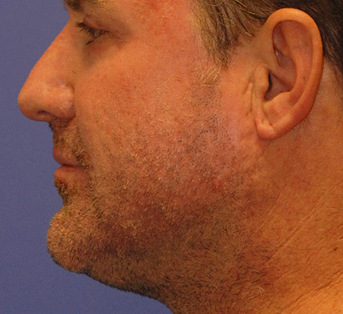 After MaxFX CO2 Laser Resurfacing patient