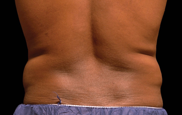 Patient 8 before photo of Coolsculpting patient at Sensational Skin Scottsdale
