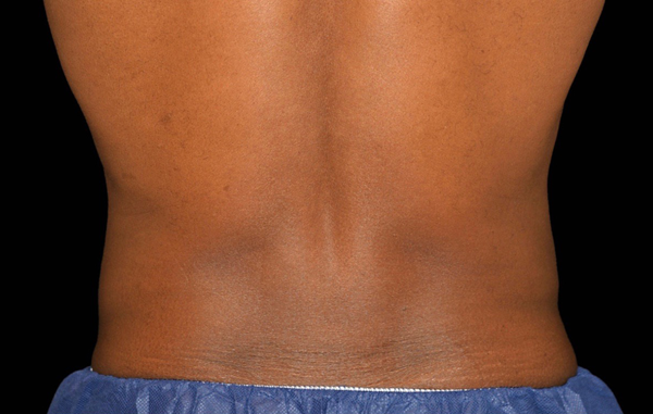 Patient 8 after photo of Coolsculpting patient at Sensational Skin Scottsdale