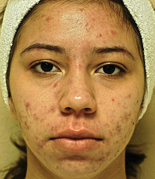 Patient 2 before photo of Acne & Acne Scar Laser Treatment patient at Sensational Skin Scottsdale